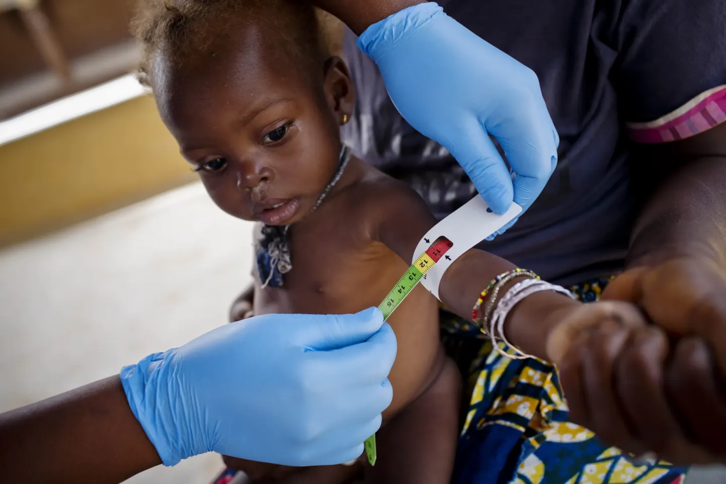 Mariama Lansanna, who is 35 years old, holds her baby Hawa, who is showing signs of malnutrition, while her middle upper arm circumference is measured at the health centre in Juru, near Kenema in Sierra Leone Thursday, Feb. 25, 2016. Since 2010, UNICEF have supported the Government of Sierra Leone&rsquo;s Free Health Care initiative for pregnant and lactating women, and children under five, reducing the number of child deaths.